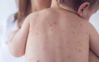 Симптомы ветрянки у детей