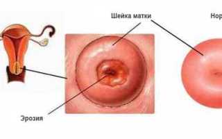 Симптомы эрозии шейки матки и её причины