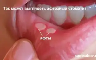 Афтозный стоматит причины симптомы лечение