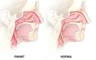 Как лечить хронический насморк