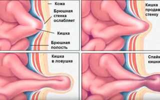 Симптомы грыжи