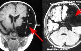 Опасна ли киста мозжечка