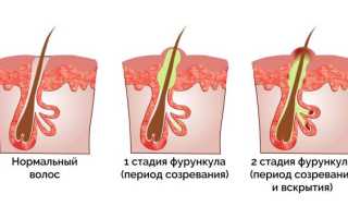 Лечение фурункулов