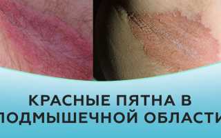 Красные пятна в подмышках – болезнь или раздражение