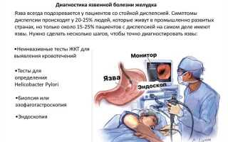 Как вылечить язву двенадцатиперстной кишки