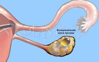 Киста яичника – симптомы, причины и лечение