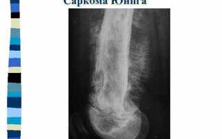 Саркома Юинга: симптомы и проявления