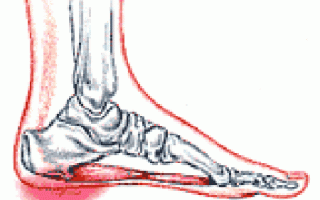 Как лечить шпору на пятке