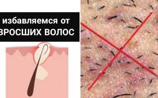 Как избавиться от вросших волос