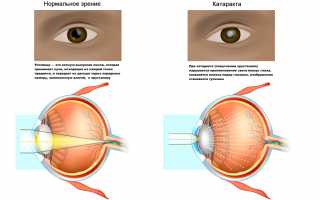 Как лечить куриную слепоту