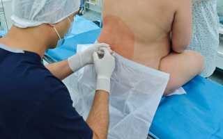 Спинальная анестезия при кесаревом сечении