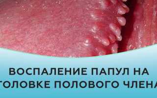 Наросты на головке полового члена