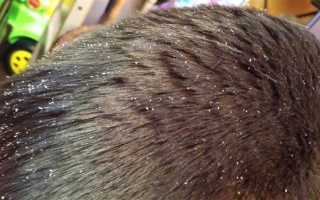 Перхоть у детей, что делать