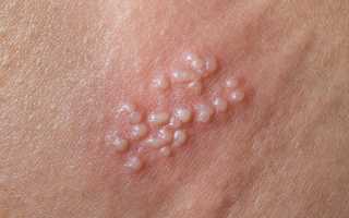 Герпис генитальный – пузырьки на наружных половых органах