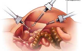 Лапароскопия в гинекологии