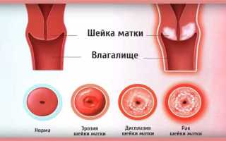 Как лечить эрозию шейки матки