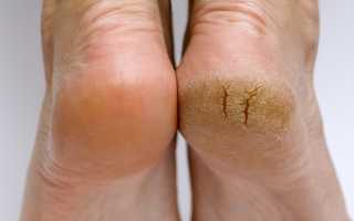 Как избавиться от трещин на пятках в домашних условиях