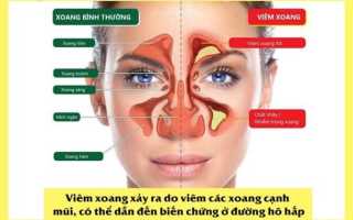 Как лечить гайморит в домашних условиях у детей