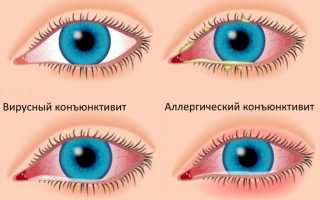 Как лечить детский конъюнктивит