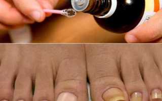 Как избавиться от грибка ногтей на ногах народными средствами