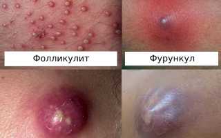 Чем лечить фурункул