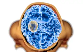 Ретроцеребеллярная арахноидальная киста – симптомы, причины, диагностика и лечение