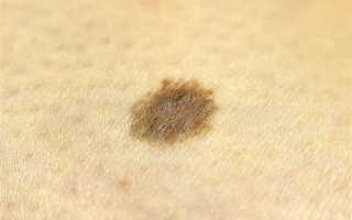 Симптомы рака кожи