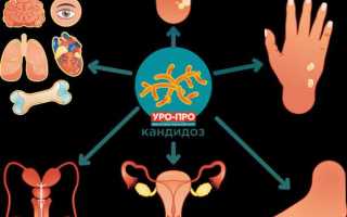 Как избавиться от кандидоза