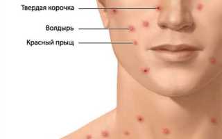 Чем лечить ветрянку