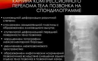 Как лечить компрессионный перелом позвоночника