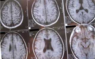 Лечение кисты прозрачной перегородки