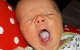 Симптомы молочницы во рту