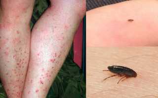 Как избавиться от блох у человека