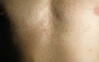 Как лечить разноцветный лишай