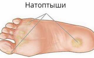 Как избавиться от натоптышей на ступнях