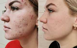 Как лечить акне
