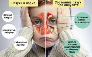 Как избавиться от гайморита навсегда