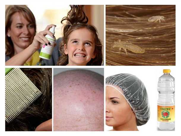 Как избавиться от гнид и вшей Как избавиться от гнид и вшей