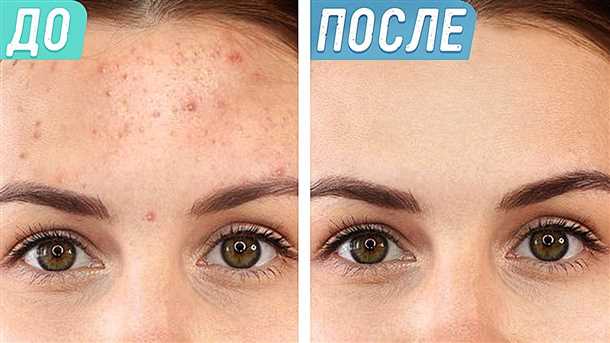 Как избавиться от угрей на лице в домашних условиях