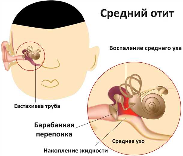 Как вылечить отит у ребенка?