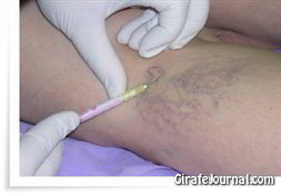 Методики лечения варикоза на ногах в современной медицине фото Методики лечения варикоза на ногах в современной медицине фото