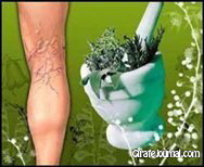 Лечение и профилактика проблемы варикоза фото Лечение и профилактика проблемы варикоза фото