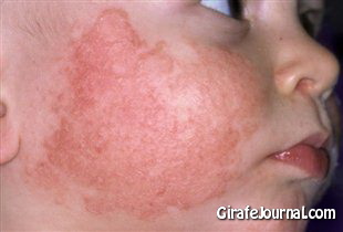 Чем лечить аллергию на солнце фото Чем лечить аллергию на солнце фото