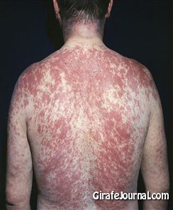 Чем лечить аллергию на солнце картинка Чем лечить аллергию на солнце картинка