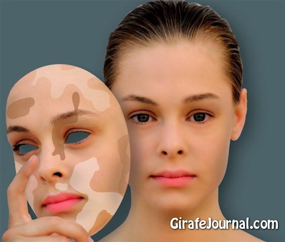 Как лечить витилиго народными средствами фото